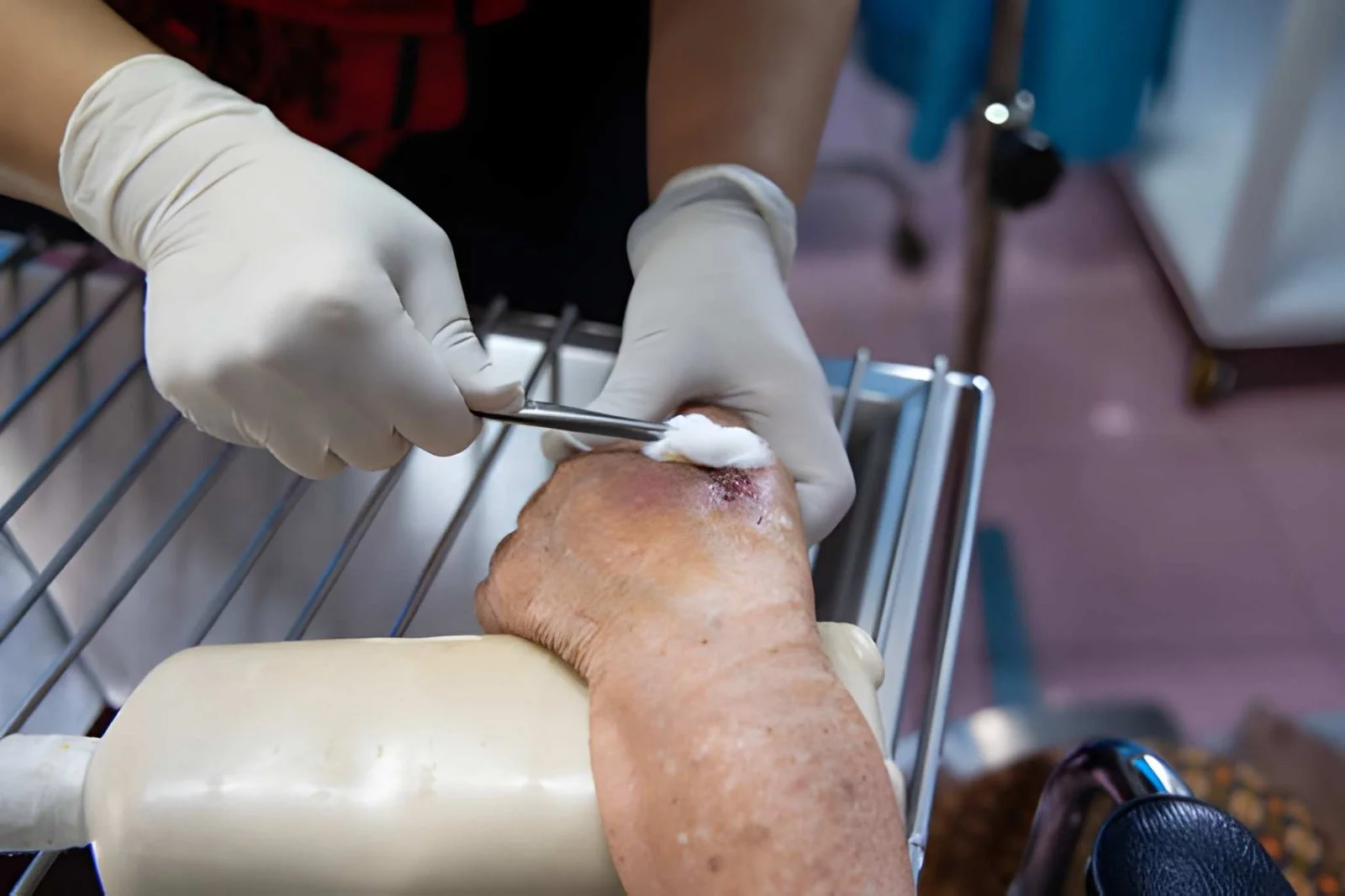Debridement