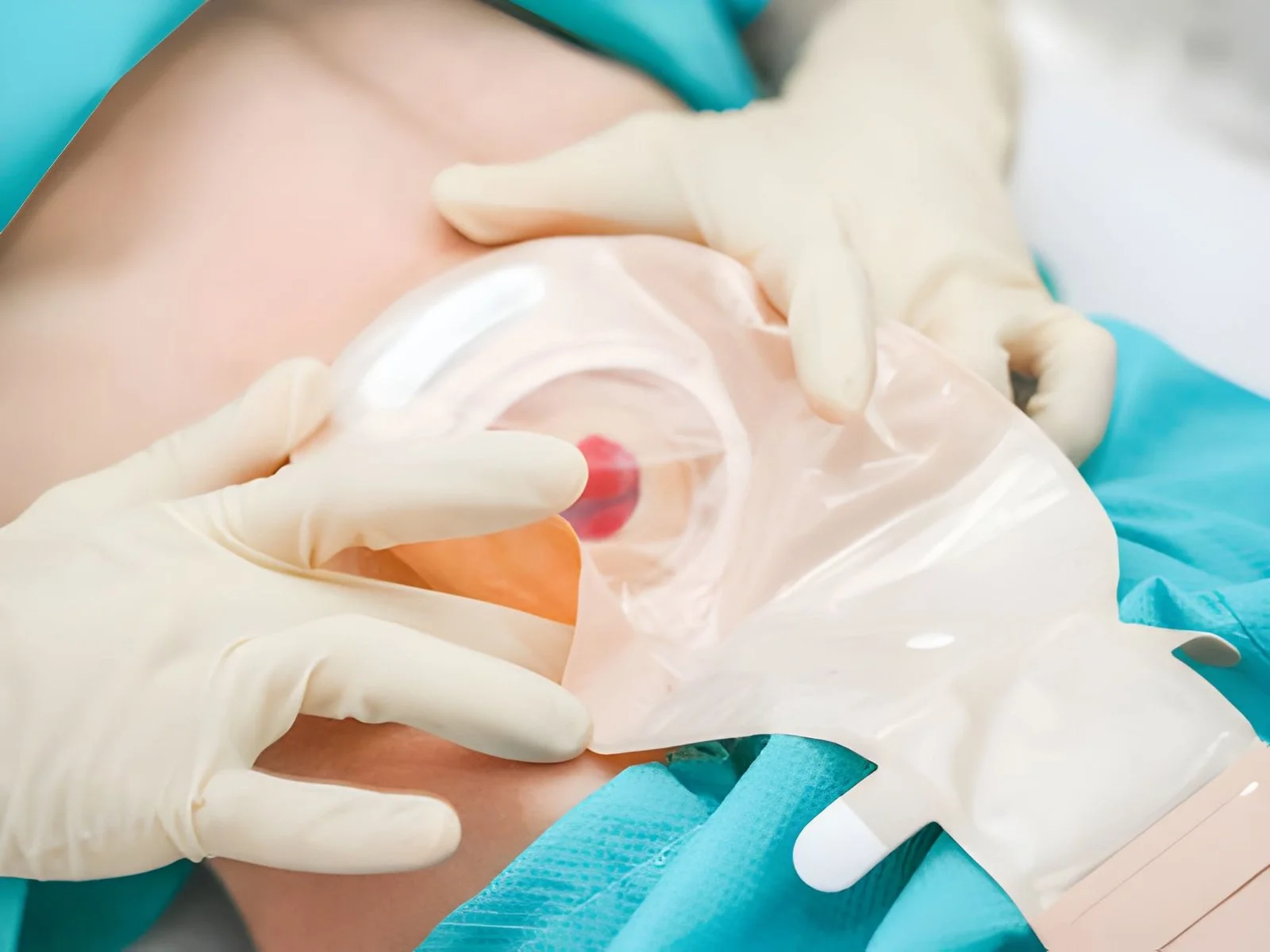 Ostomy Care