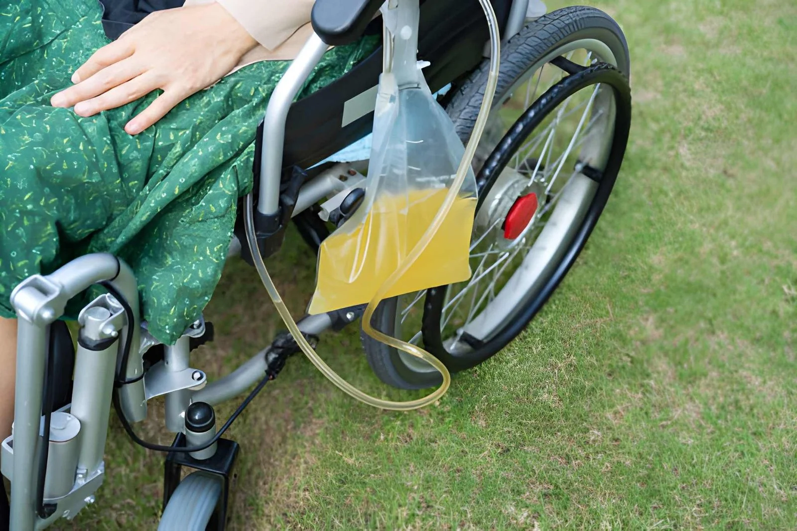 Suprapubic Catheter Care